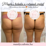 Alakformáló kezelés eredmény – előtte és utána fotó a Mandy’s Beauty & Shape szalonban Budapesten