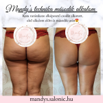 Alakformáló kezelés előtte és utána fotó a Mandy’s Beauty & Shape szalonban Budapesten – narancsbőr eltüntetése