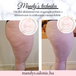 Alakformáló kezelés eredménye előtte–utána fotón – Dia masszőr cellulit csökkentő és bőrfeszesítő terápiája a Mandy’s szalonban